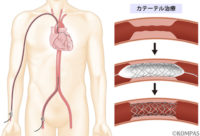 冠動脈カテーテル治療 – 循環器内科.com